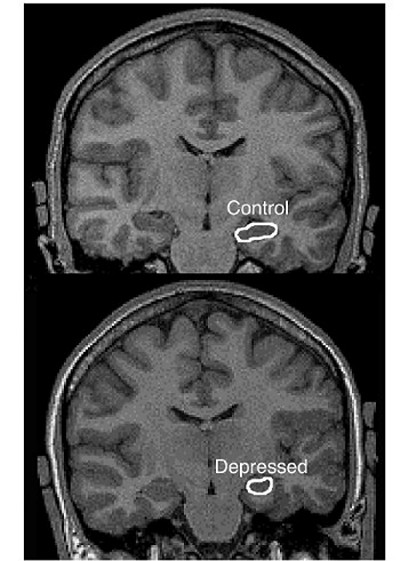 diminished Hippocampus in Depression